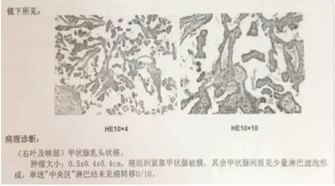 別慌，甲狀腺疾病還可以這樣投保！